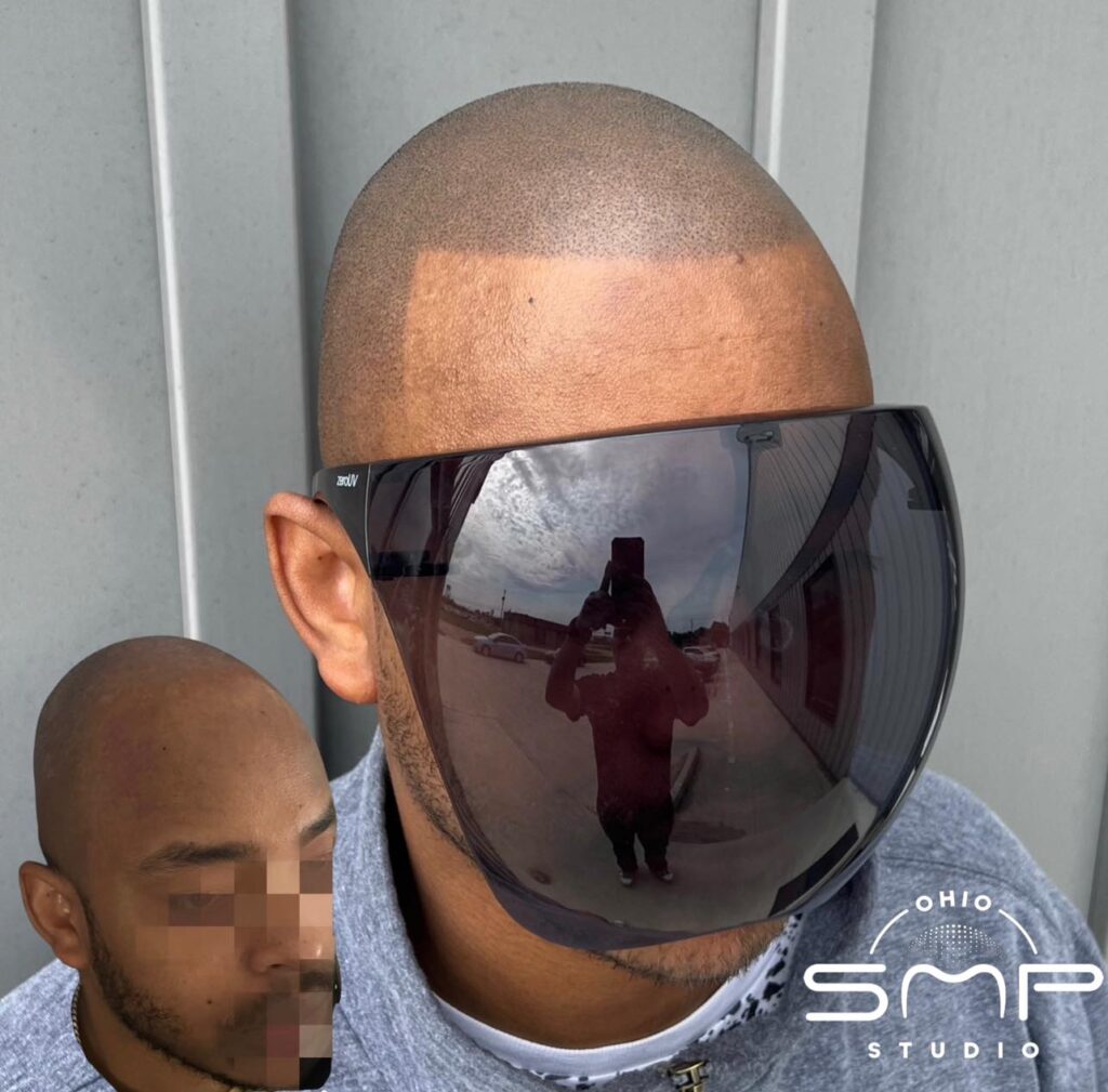 Scalp Micropigmentation